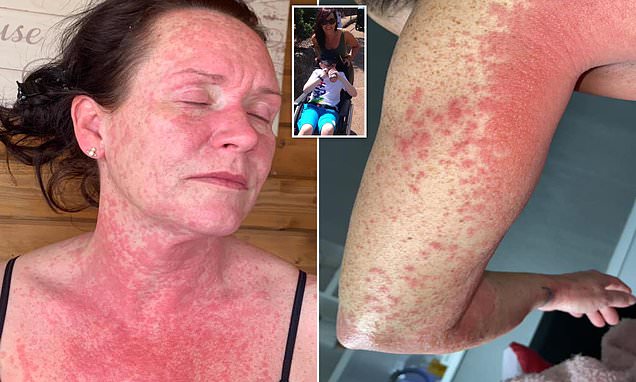 mother-s-face-arm-and-chest-erupts-in-agonising-red-rash-after-getting