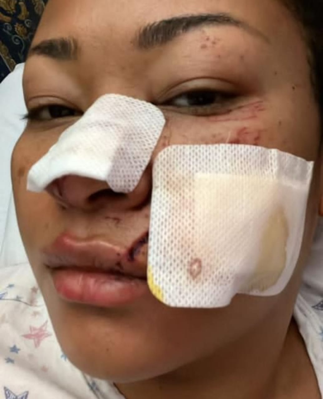 Natasha Akpoti shows extent of her injuries after surviving road accident